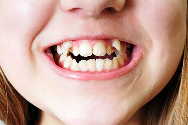 آیا با رشد فرزندم، نامرتبی های دندانی کمتر می شوند؟