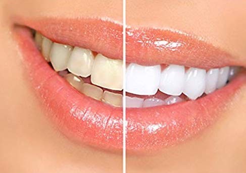 سفید کردن دندان‌ها